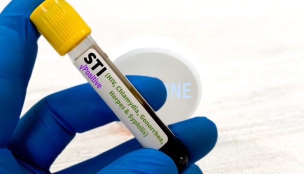 Biochemist,Or,Lab,Technologist,Holds,Blood,Sample,For,Sti,Or