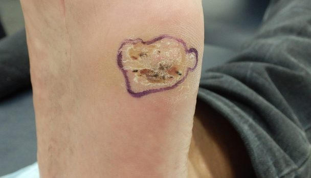 ep 8. Plantar and cutaneous warts