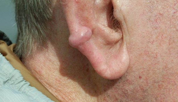 ep 9. JT - consented - keloid scar (use this one instead)